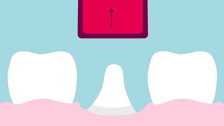 Cupcake Rau Gingival expander RAUMEDIC Cupcake – RAUMEDIC